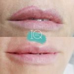 Formation IQ remover